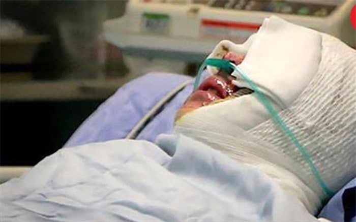 Man severely injures ex-wife in acid attack in Iran’s Mashhad