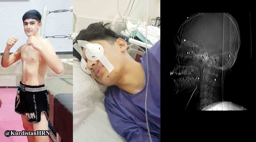 گزارشی از وضعیت یک کودک اهل پیرانشهر که در اثر تیراندازی نیروهای نظامی بینایی یک چشم خود را از دست داد